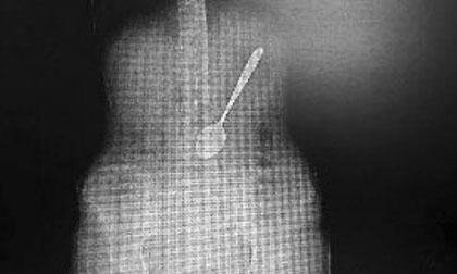 Cô gái nuốt phải chiếc thìa dài 15 cm khi ăn mì