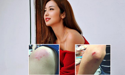 Fans xót xa trước hình ảnh bầm dập của Jennifer Phạm