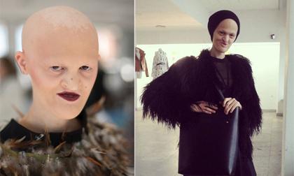 Người mẫu thành công nhờ có khuôn mặt dị dạng