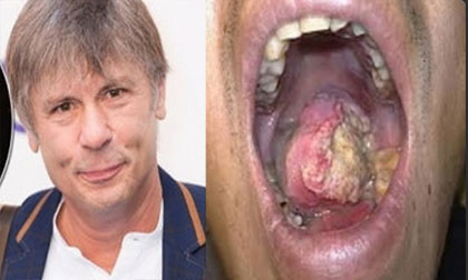 Nam ca sĩ Anh ung thư lưỡi vì 'quan hệ' bằng miệng quá nhiều