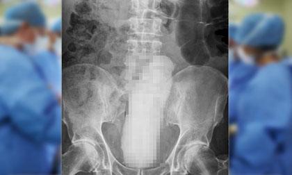 Cụ ông 68 tuổi bị mắc kẹt 'cậu nhỏ' giả dài 23cm ở ruột già