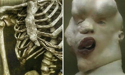 Khám phá bí ẩn về 'người voi'