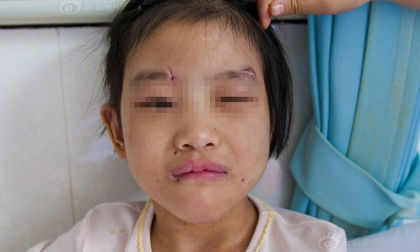 Bé gái 6 tuổi bị mẹ kế hành hạ, đánh đập đến gãy xương