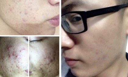 Từ ‘vịt bầu’ hóa hotboy, hotgirl nhờ trị mụn thành công 'gây sốc'