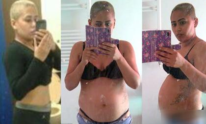 Bụng to như mang bầu vì vòng tránh thai