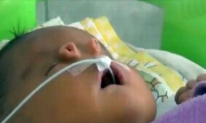 Em bé có hai mũi kỳ lạ