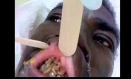 Người đàn ông bị ổ giòi ký sinh trong miệng