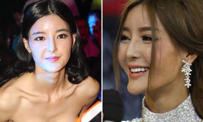 'Mỹ nhân dao kéo' Lý Dĩnh Chi bị nghi tháo cằm độn