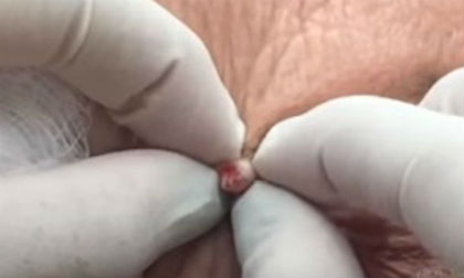 Cận cảnh lấy 'mẹ của mụn đầu đen' gần khu vực mắt