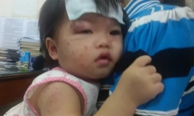 Bé 11 tháng tuổi bị bạn cắn, cào nát mặt khi đi nhà trẻ