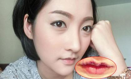 Cô gái cắt bớt môi để sở hữu khuôn miệng nhỏ xinh