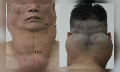 Sở hữu khối u to như cổ ngựa vì uống 2 lít rượu mỗi ngày