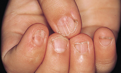  8 biểu hiện cảnh báo cơ thể thiếu sắt có nguy hại tới sức khỏe