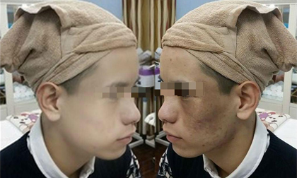Từ ‘vịt bầu’ hóa hotboy nhờ xóa chàm, bớt bẩm sinh thành công 'gây sốc'