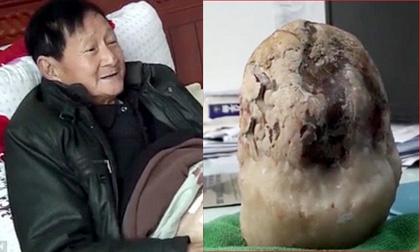 Cụ ông 70 tuổi có sỏi mật lớn bằng quả dưa