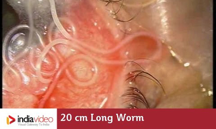 Cảnh gắp giun dài 20cm ký sinh trong mắt người