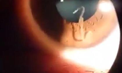 Phát hiện con giun 'quằn quại' trong mắt người