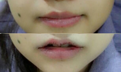 Loạt ảnh trước và sau khi phẫu thuật cắt môi đầy đau đớn của giới trẻ