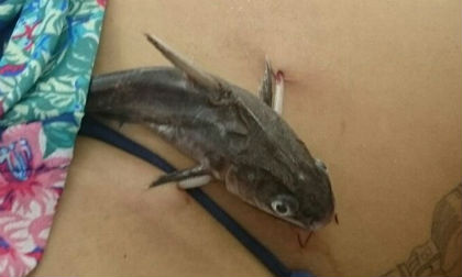 Người phụ nữ bị cá da trơn đâm thẳng gai vào mạng sườn