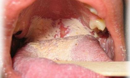 Nhìn vấn đề của lưỡi đoán biết bệnh tật cơ thể