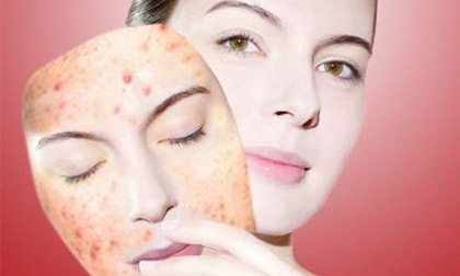 Hết mụn đón Tết trong vài nốt nhạc!