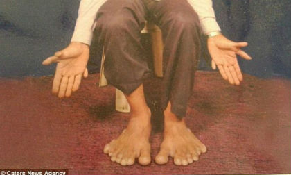 Người đàn ông 'dị nhân' có 14 ngón tay, 14 ngón chân