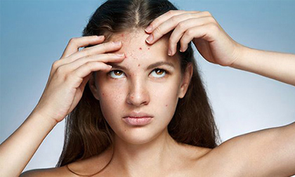 Không lo mụn 'quấy nhiễu' ngày Tết!