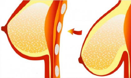 Làm thế nào để ngăn chặn chảy xệ ngực 