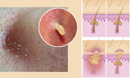 Đánh bật mụn đầu đen bằng công thức đơn giản tại nhà