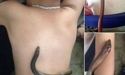 Dùng lươn sống chườm hạ sốt cho trẻ: Cực kỳ nguy hiểm!