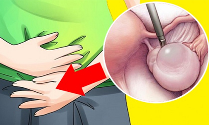 U nang buồng trứng và cách chữa trị sớm