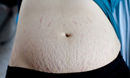 Khắc phục rạn da sau sinh