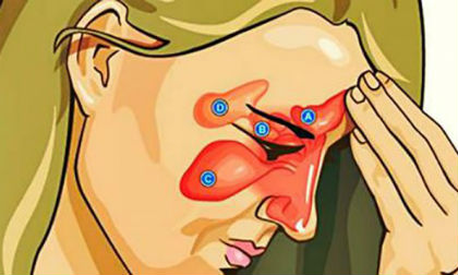 Chữa viêm xoang cực đơn giản và hiệu quả với giấm táo