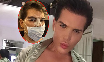 'Búp bê Ken' đời thực bị hoại tử mũi vì 'nghiện' phẫu thuật