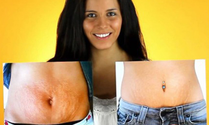 Tự tin với làn da không còn vết rạn