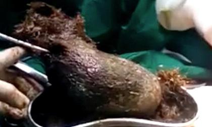 Thiếu niên nuốt búi tóc gần 1kg trong dạ dày