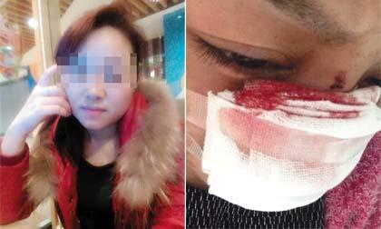 Người vợ bị chồng cắt mũi và đánh đập dã man