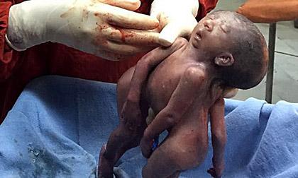 Hình ảnh đau lòng của cặp song sinh chung não