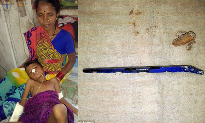 Nuốt nhầm bàn chải đánh răng vào bụng, một năm không phân hủy