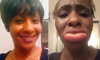 Người phụ nữ môi sưng phồng đáng sợ vì dị ứng son