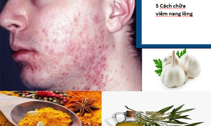 5 loại thảo mộc chữa viêm nang lông