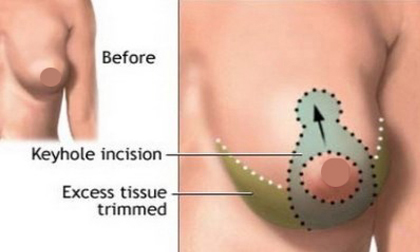 9 biện pháp giảm xệ võng ngực