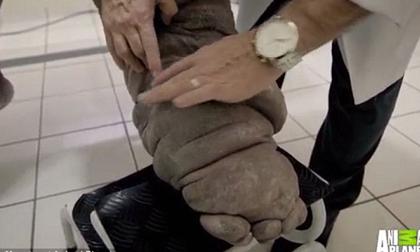 Người đàn ông có chân sưng phù đáng sợ sau khi bị muỗi đốt