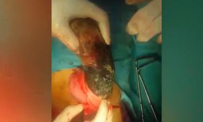  Lấy búi tóc nặng 3kg từ dạ dày