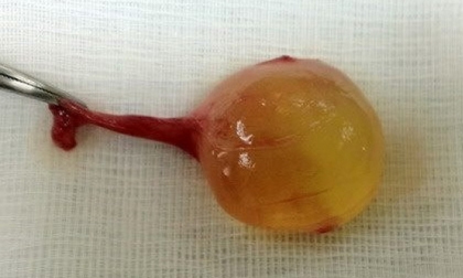 Tá hỏa vì con trai bỗng dưng có 3 tinh hoàn