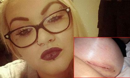 Cô gái Anh bị 'nổ ngực' vì ham phẫu thuật giá rẻ