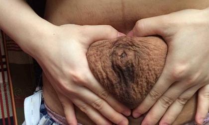 Sợ chồng nhìn thấy vết rạn da, vợ bắt tắt điện khi gần gũi