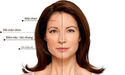 Botosonic HIFU - Nâng cơ trẻ hóa da một lần duy nhất