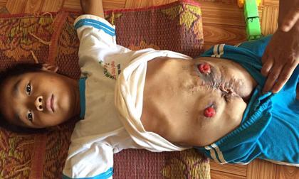 Đau lòng trước hình ảnh em bé không có hậu môn, bộ phận sinh dục