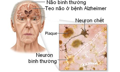 Một số loại thuốc không kê đơn có thể gây teo não